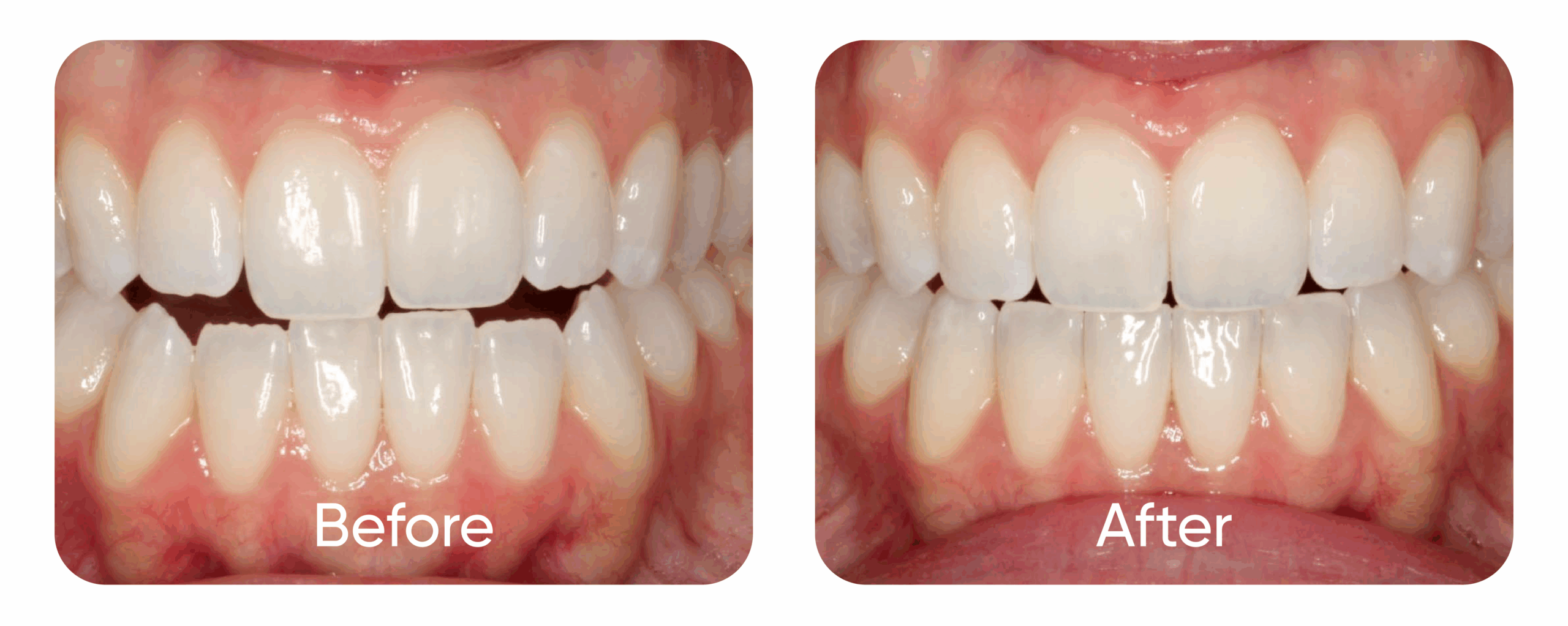 Teeth before and after orthodontic touch-up